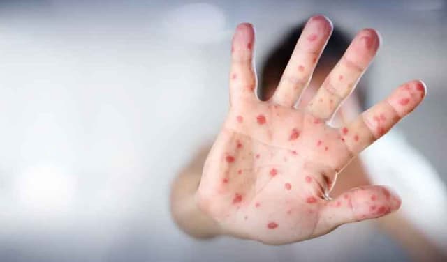 53 children die from measles in Sindh this year 53 children die from measles in Sindh this year