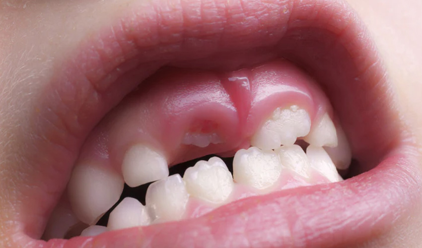 Breakthrough drug to regrow teeth set for human trials